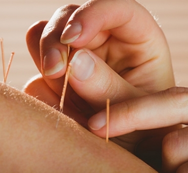 Acupuntura